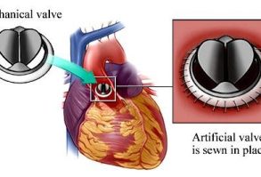 Bileaflet valve
