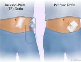 درن گردنه‌ی رحم Cervical Drain