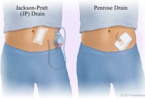 درن گردنه‌ی رحم Cervical Drain