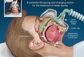 CPAP 