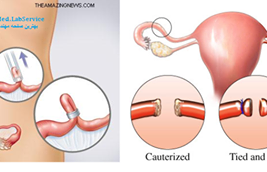 Laparoscopic tubal sterilisation