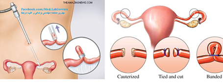 Laparoscopic tubal sterilisation
