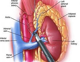 Transperitoneal Laparoscopic Adrenalectomy