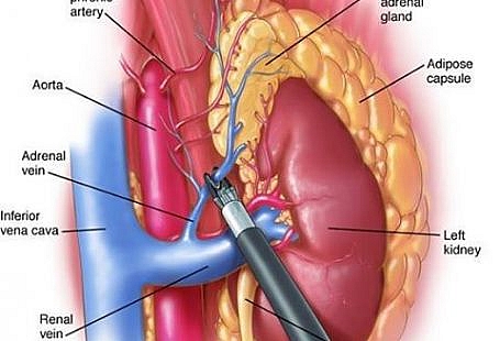 Transperitoneal Laparoscopic Adrenalectomy
