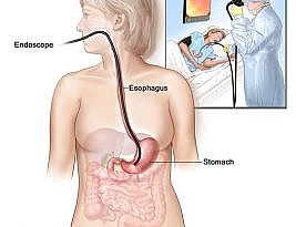 Endoscopic Stomach Polyp Removal