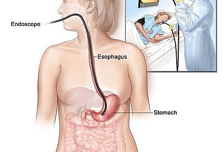 Endoscopic Stomach Polyp Removal