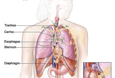 Pathophysiology of Non-small Cell Lung Cancer