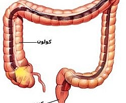 کولونوسکوپی