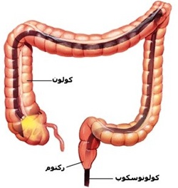 سی تی کولونوسکوپی ( CTC )
