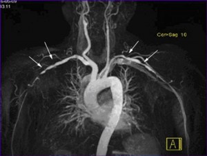 آنژیوگرافی گردن با MRI