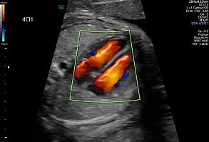 Fetal Echocardiogeraphy