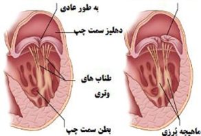 Mitral Valve Prolapse